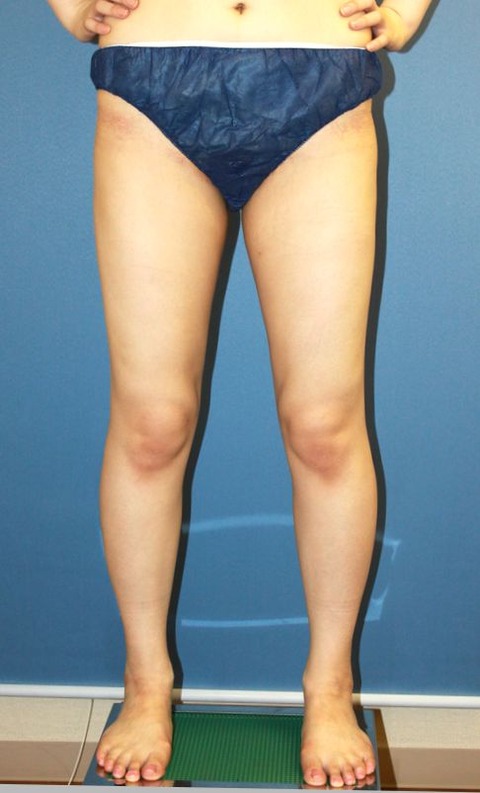 20161228po9M大腿正面