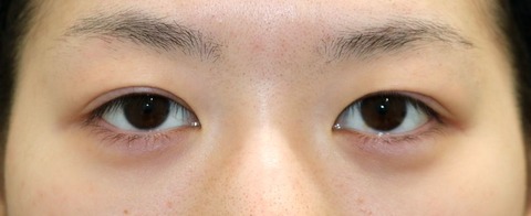 20170302術前目元