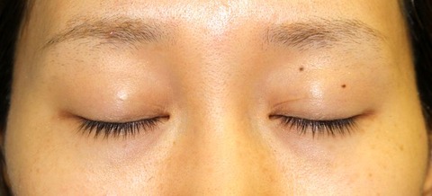 20160929po6M目もと閉瞼