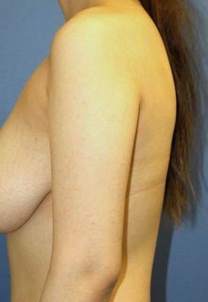 20160908術前左腕横