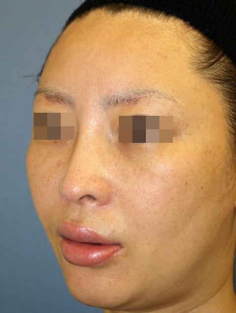 20161128 po2W斜め - コピー