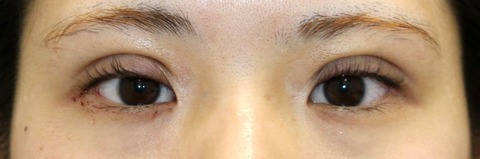 20161121術後目元