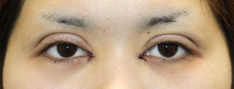 20170216術後目元