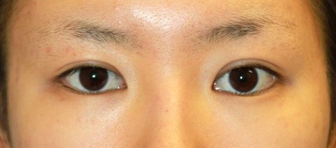 20160829術前目もと２