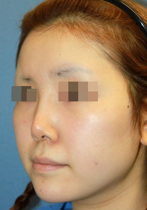 20160831術前斜め