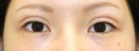 術後目元20160808