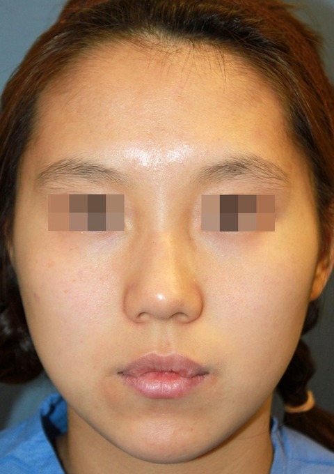 20160908術前正面