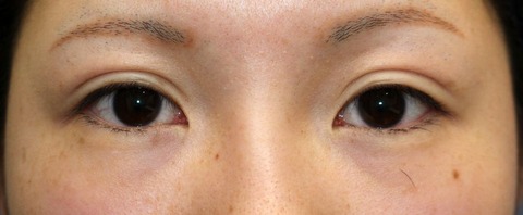 20170123po6M目元②