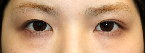 20170427術前目元