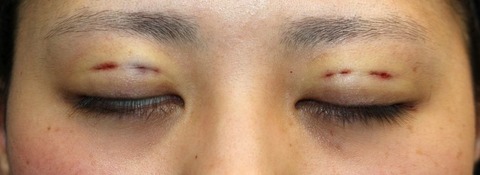 20170112術後目元閉眼