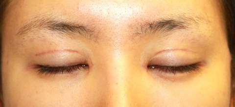 20160829po1M目もと閉瞼