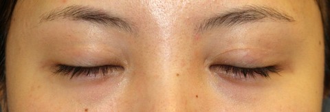 20161221po6M目元閉瞼