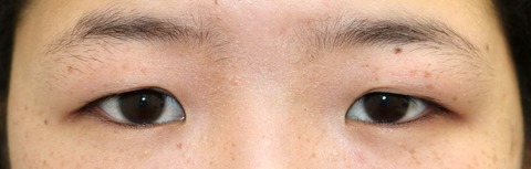 20170112術前目元