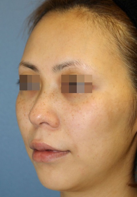 20161128施術開始後3M斜め