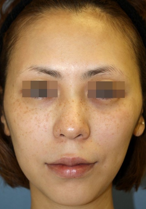 20161128施術開始後3M正面