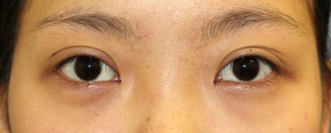 20161126術前目元