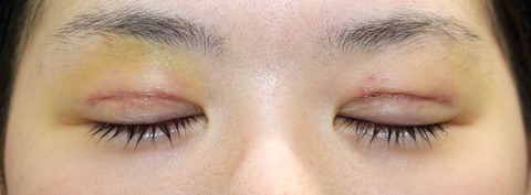 20170302po1W目元閉眼