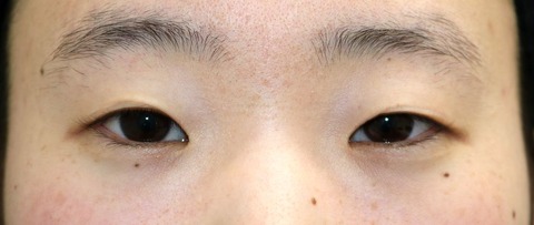 20170311術前目元