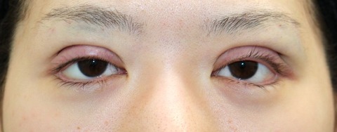 20170302術後目元