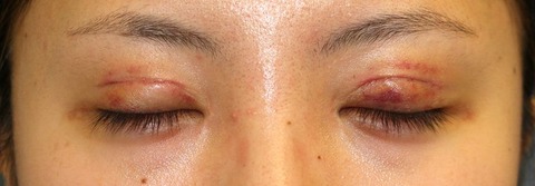 20160810pod4目元閉瞼