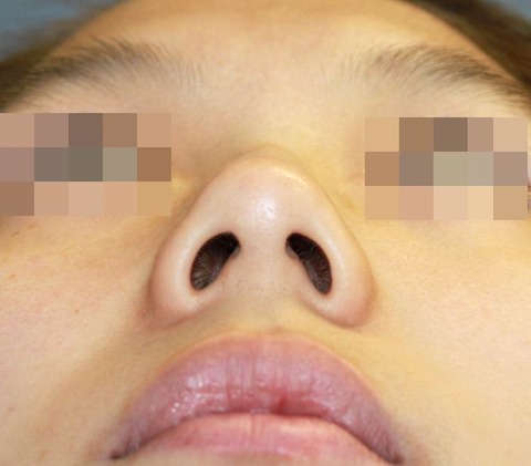 20160908術前あおり