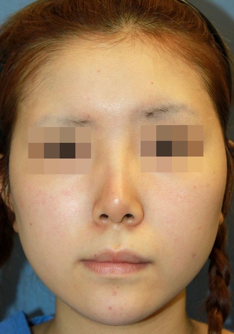 20160831術前正面