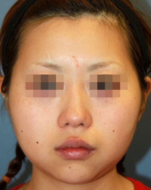 20160816術前正面