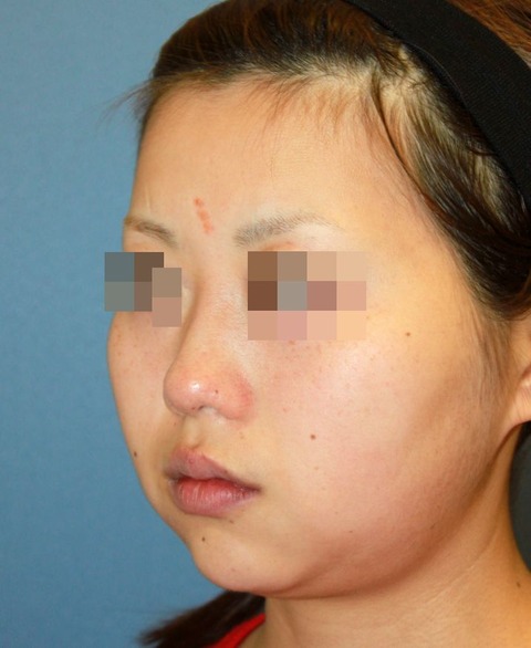 20160816術前斜め