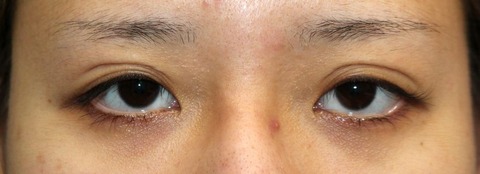 20170208術前目元