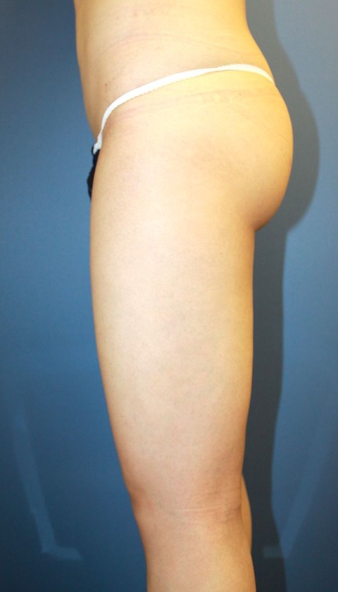 20160906po1M左大腿横