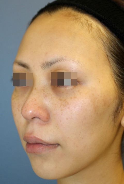 201611282回目施術前左斜め