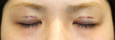 20170427術後目元閉眼