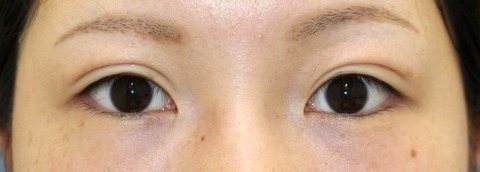 術前目元20160808