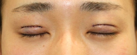 20170410術後目元閉眼