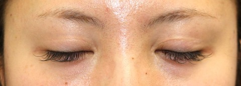 20170214po1Y目元閉瞼