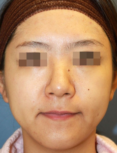 20160823術前正面