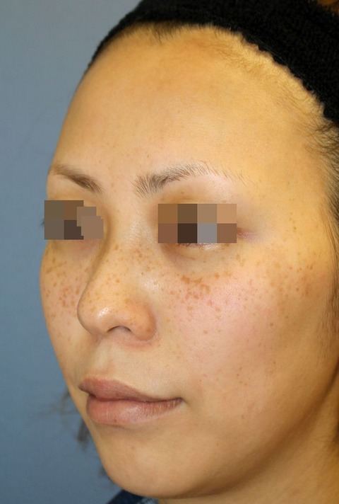 20161128施術前斜め