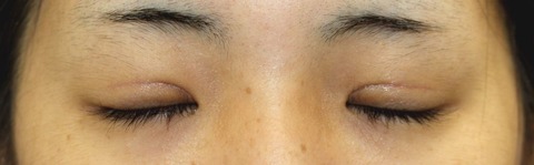 20161121po2M目元閉瞼