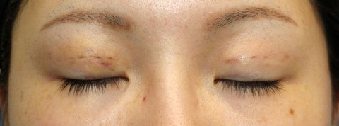 20160818pod3目元閉瞼