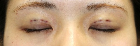 20161121術後目元閉瞼