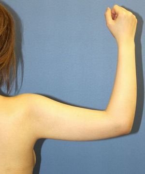 20160908術前右腕後面