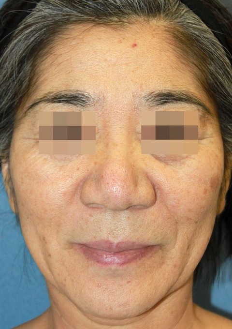 20161013術前正面