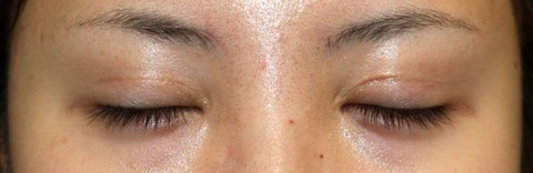 20161010po2M目元閉瞼