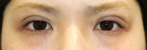 20170427術後目元