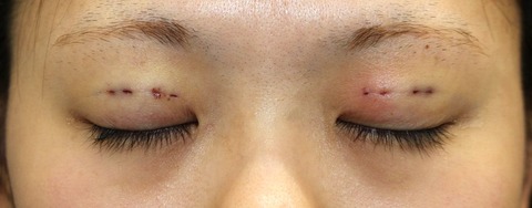 20170107術後目元閉眼