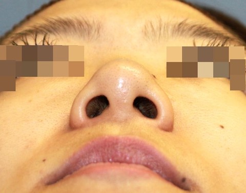 20160823術前あおり